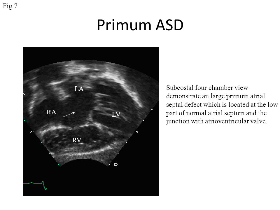 Primum ASD Fig 7 Subcostal four chamber view LA