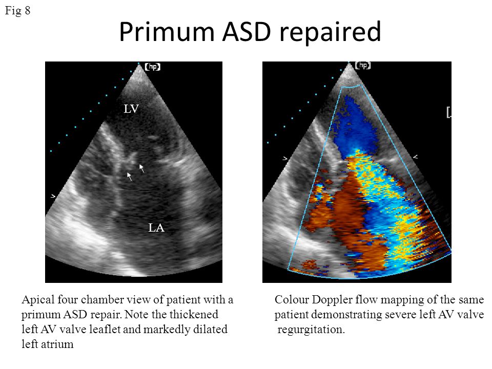 Primum ASD repaired Fig 8 LV LA