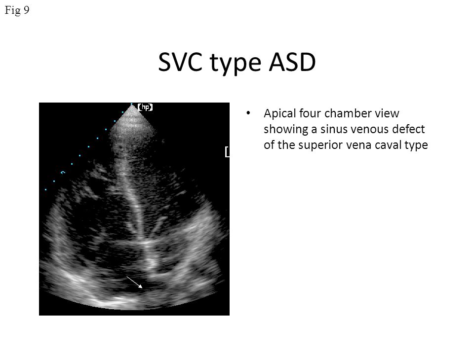 Fig 9 SVC type ASD.