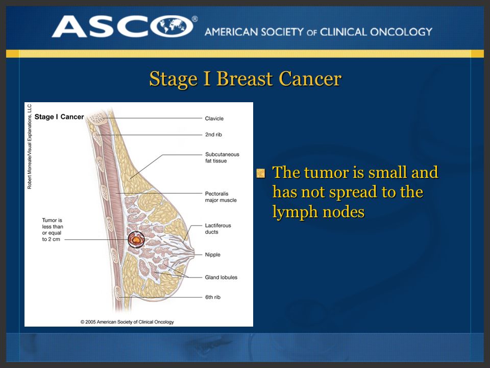 Stage I Breast Cancer The tumor is small and has not spread to the lymph nodes