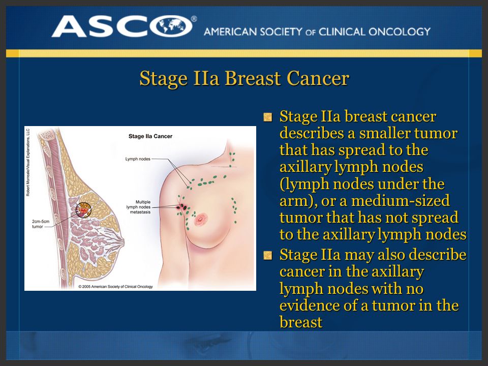 Stage IIa Breast Cancer