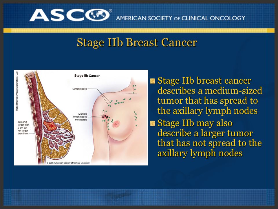 Stage IIb Breast Cancer