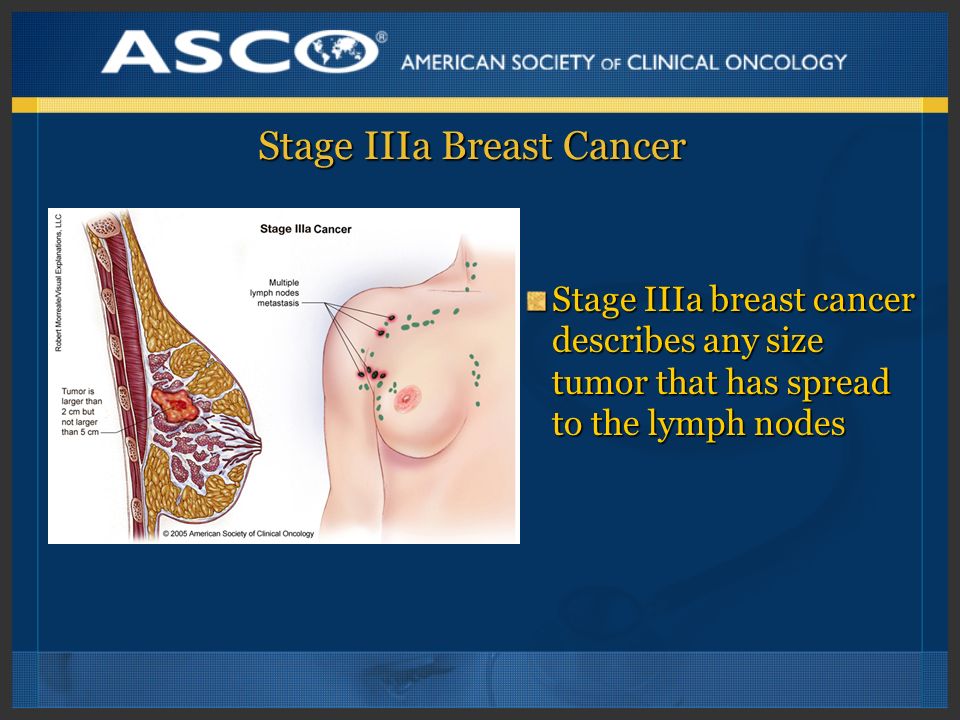 Stage IIIa Breast Cancer