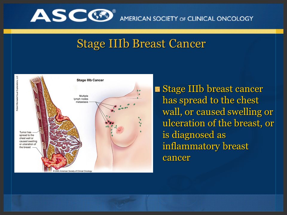 Stage IIIb Breast Cancer