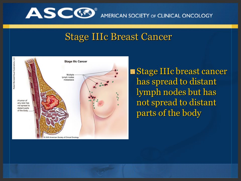 Stage IIIc Breast Cancer