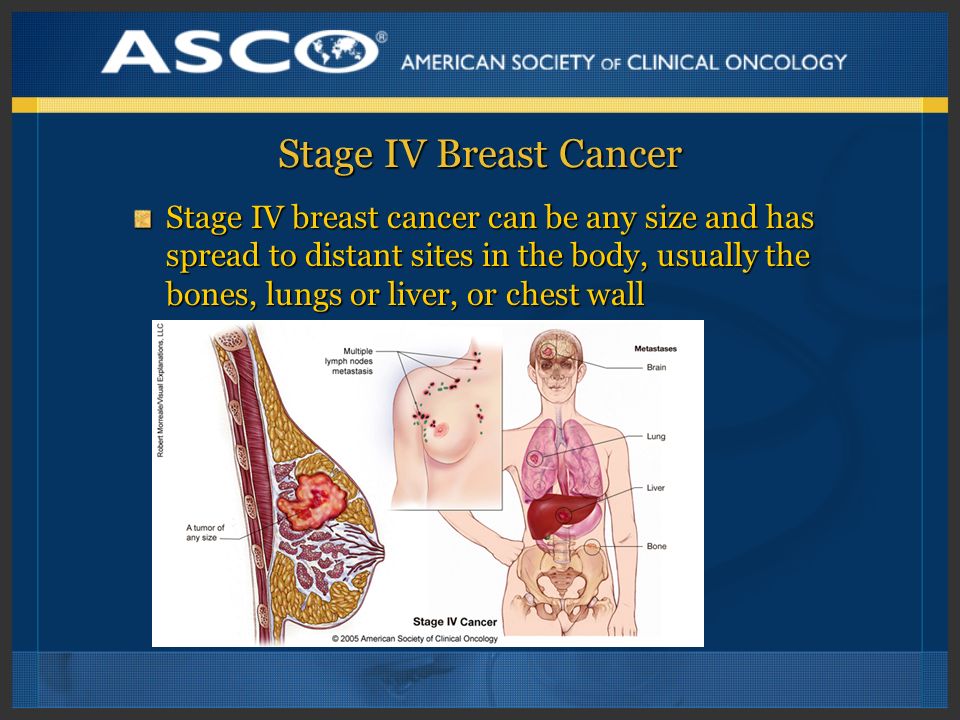 Stage IV Breast Cancer