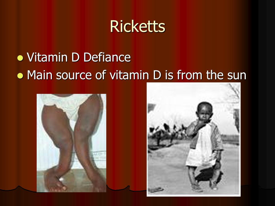 Ricketts Vitamin D Defiance Main source of vitamin D is from the sun