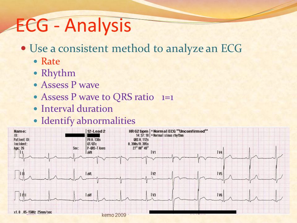 ECG - Analysis Use a consistent method to analyze an ECG Rate Rhythm