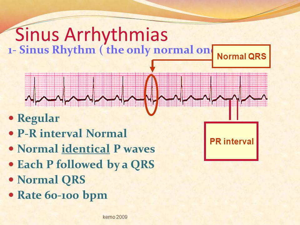 Sinus Arrhythmias 1- Sinus Rhythm ( the only normal one ) Regular
