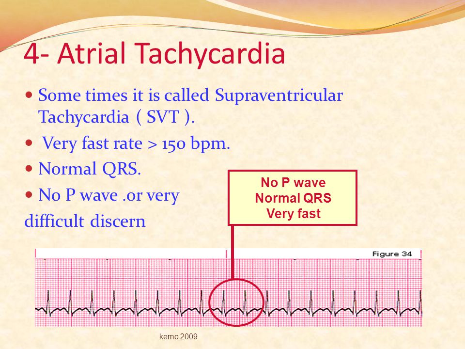 4- Atrial Tachycardia Some times it is called Supraventricular Tachycardia ( SVT ). Very fast rate > 150 bpm.