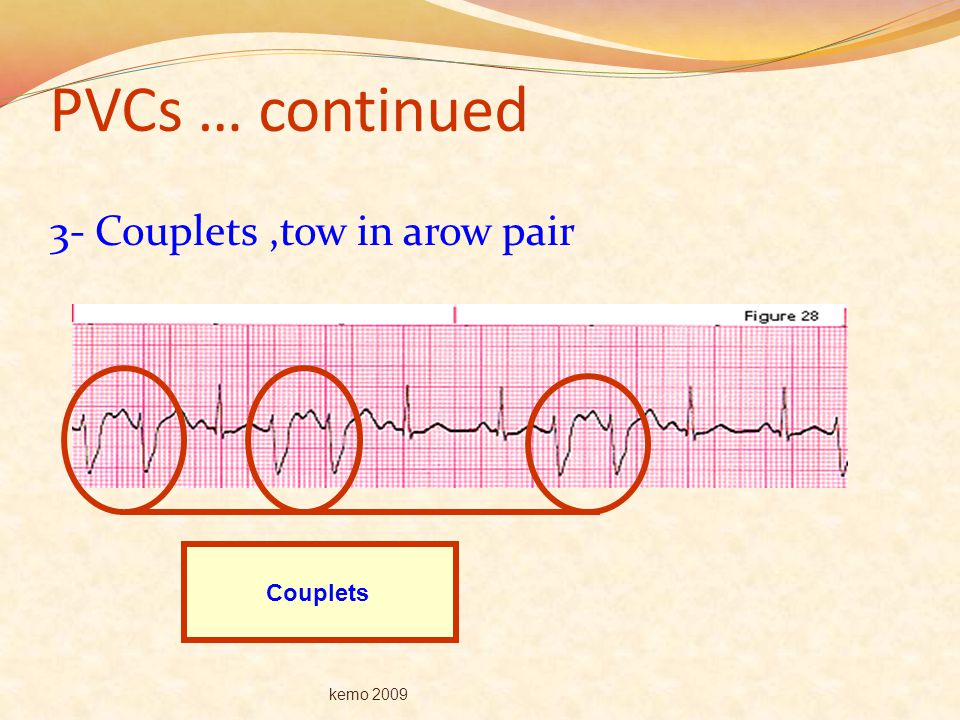 PVCs … continued 3- Couplets ,tow in arow pair Couplets kemo 2009