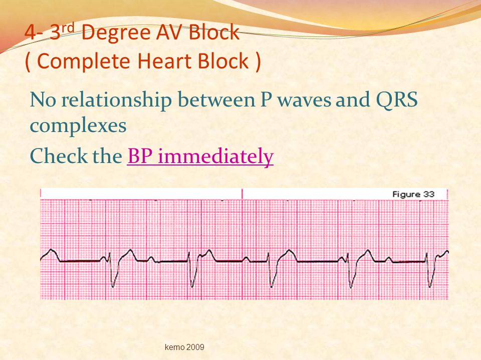 4- 3rd Degree AV Block ( Complete Heart Block )