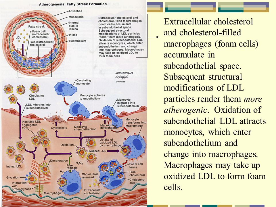 Extracellular cholesterol and cholesterol-filled macrophages (foam cells) accumulate in subendothelial space.
