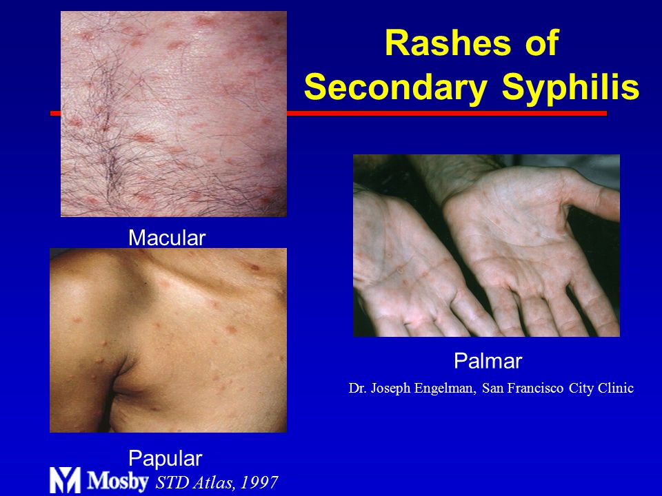 Rashes+of+Secondary+Syphilis.jpg