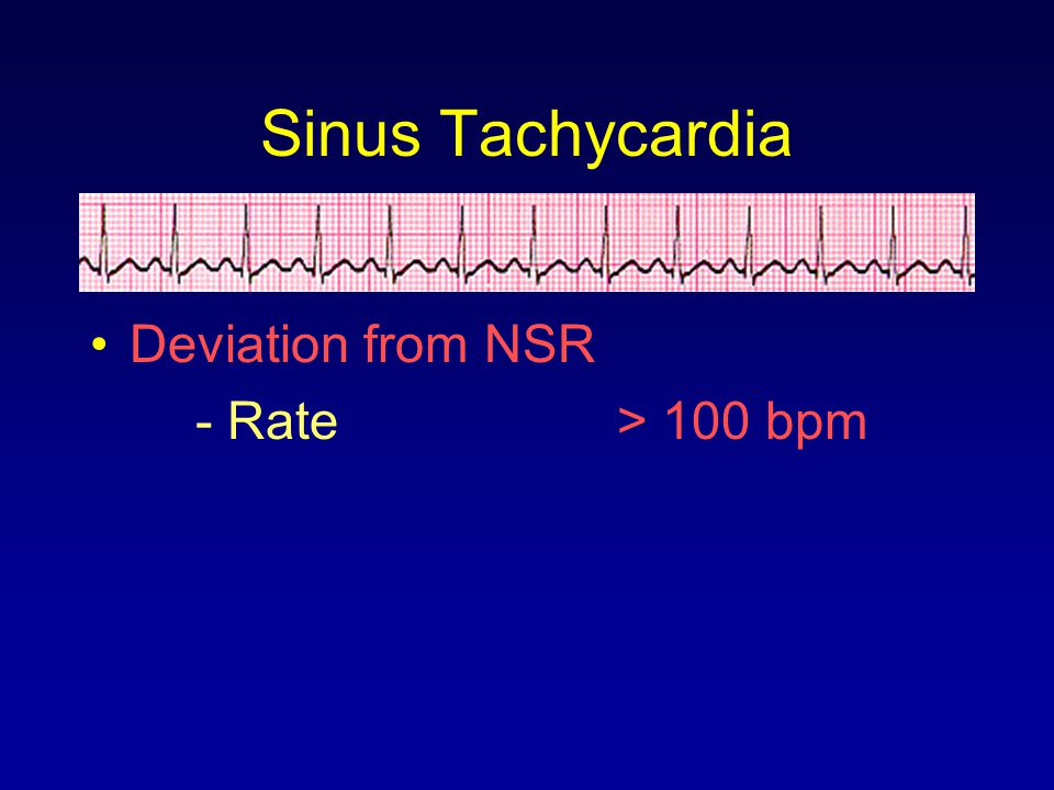 Sinus Tachycardia Deviation from NSR - Rate > 100 bpm