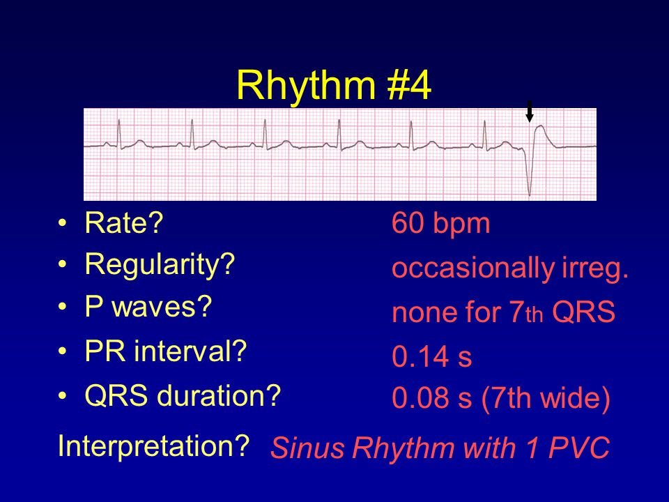 Rhythm #4 Rate 60 bpm Regularity occasionally irreg. P waves