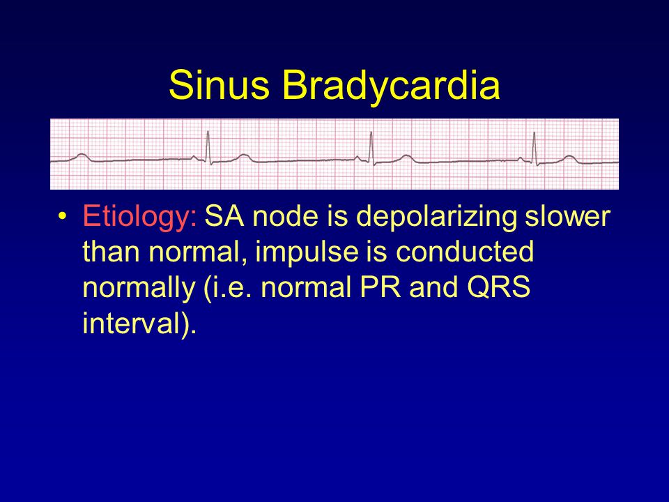 Sinus Bradycardia Etiology: SA node is depolarizing slower than normal, impulse is conducted normally (i.e.