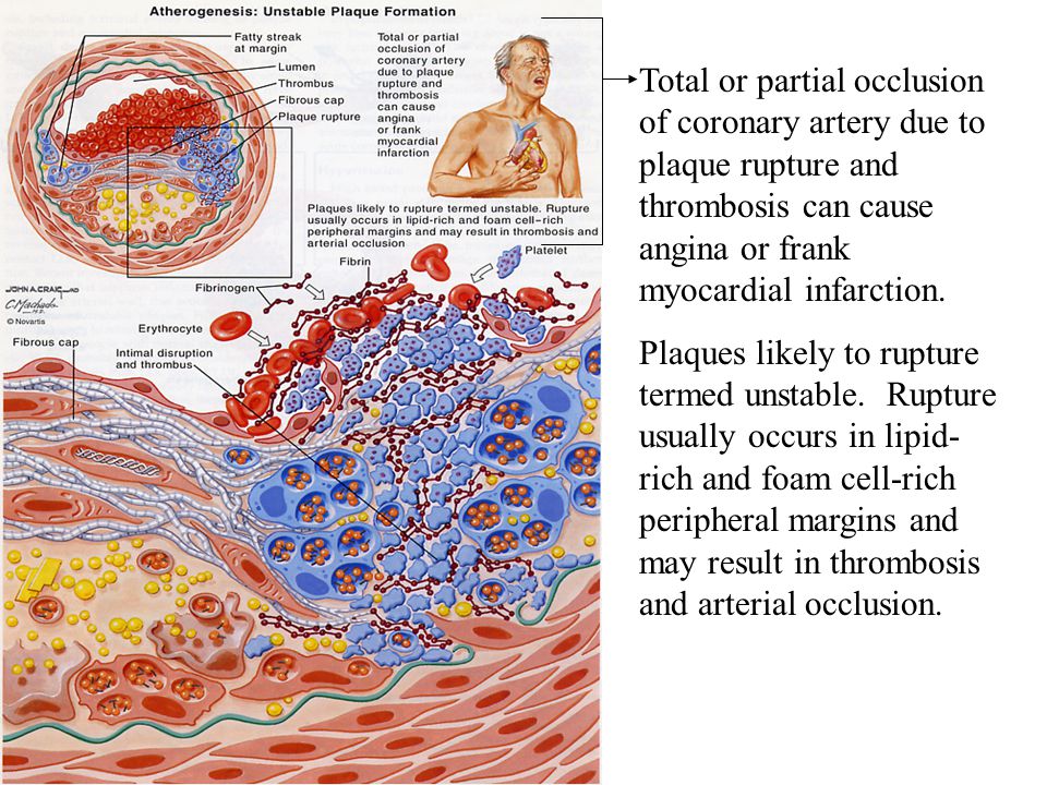 Total or partial occlusion of coronary artery due to plaque rupture and thrombosis can cause angina or frank myocardial infarction.