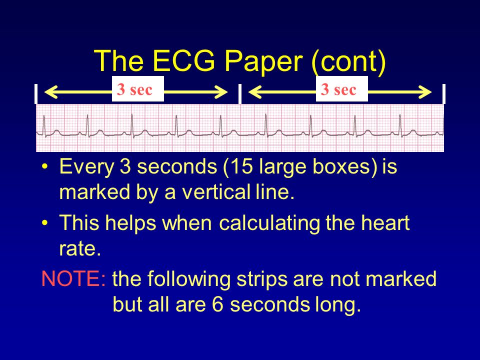 The ECG Paper (cont) 3 sec. 3 sec. Every 3 seconds (15 large boxes) is marked by a vertical line.