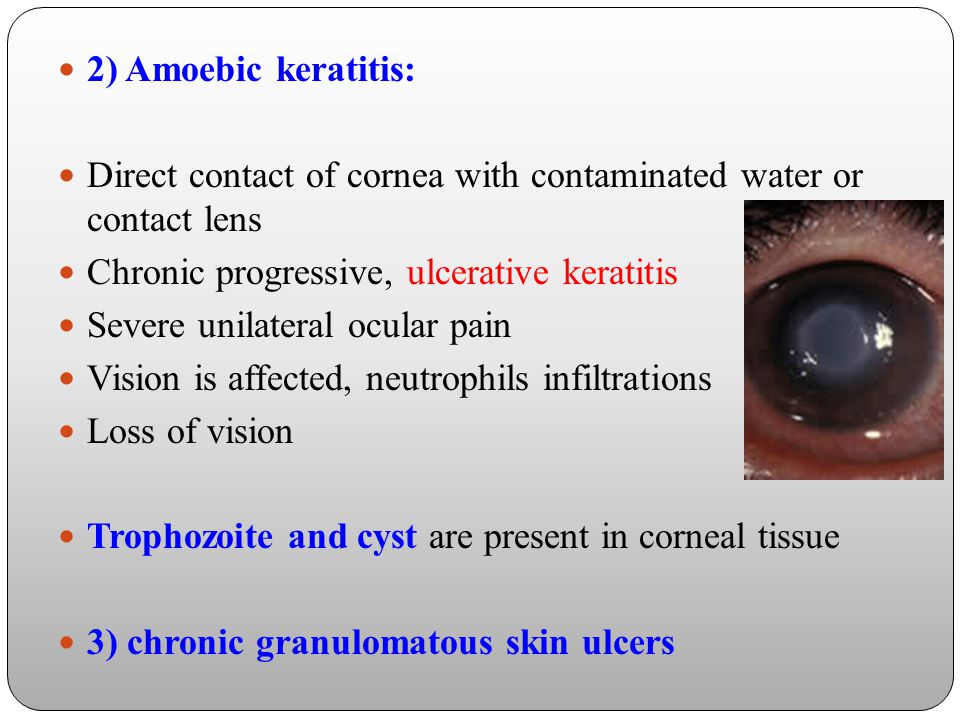 2) Amoebic keratitis: Direct contact of cornea with contaminated water or contact lens. Chronic progressive, ulcerative keratitis.