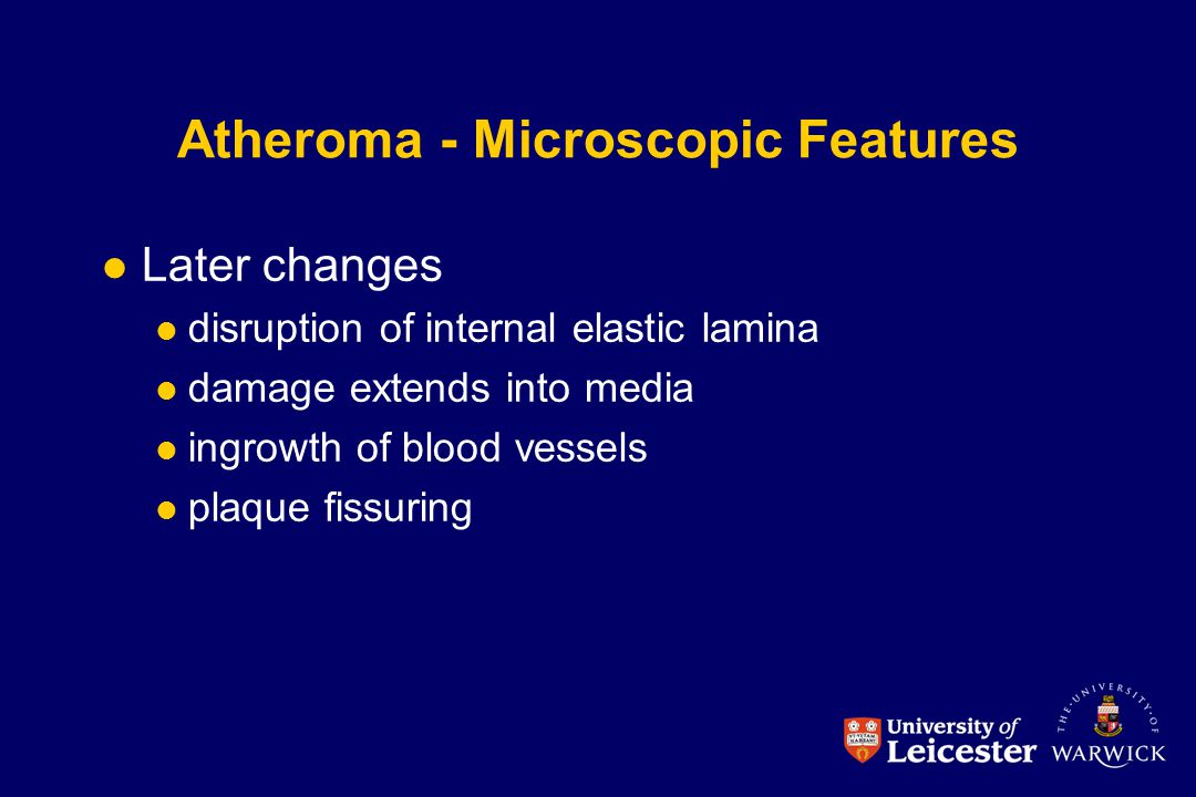 Atheroma - Microscopic Features