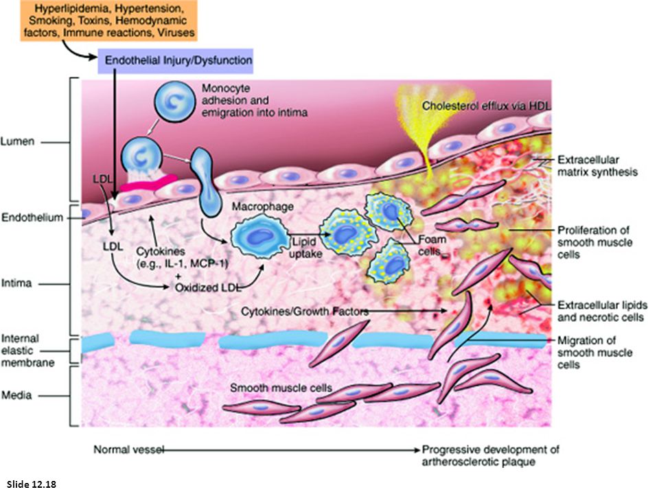 Schematic diagram of a hypothetical sequence of cell-level events and cellular interactions in atherosclerosis. Hyperlipidemia and other risk factors are thought to cause endothelial injury, resulting in adhesion of platelets and monocytes and release of growth factors, including platelet-derived growth factor (PDGF), which lead to smooth muscle cell migration and proliferation. Smooth muscle cells produce large amounts of extracellular matrix, including collagen and proteoglycans. Foam cells of atheromatous plaques are derived from both macrophages and smooth muscle cells—from macrophages via the very-low-density lipoprotein (VLDL) receptor and low-density lipoprotein (LDL) modifications recognized by scavenger receptors (e.g., oxidized LDL), and from smooth muscle cells by less certain mechanisms. Extracellular lipid is derived from insudation from the vessel lumen, particularly in the presence of hypercholesterolemia, and also from degenerating foam cells. Cholesterol accumulation in the plaque should be viewed as reflecting an imbalance between influx and efflux, and it is possible that high-density lipoprotein (HDL) helps clear cholesterol from these accumulations.