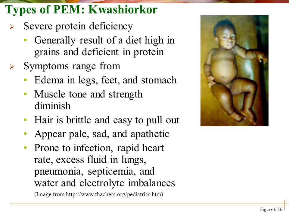 Types of PEM: Kwashiorkor