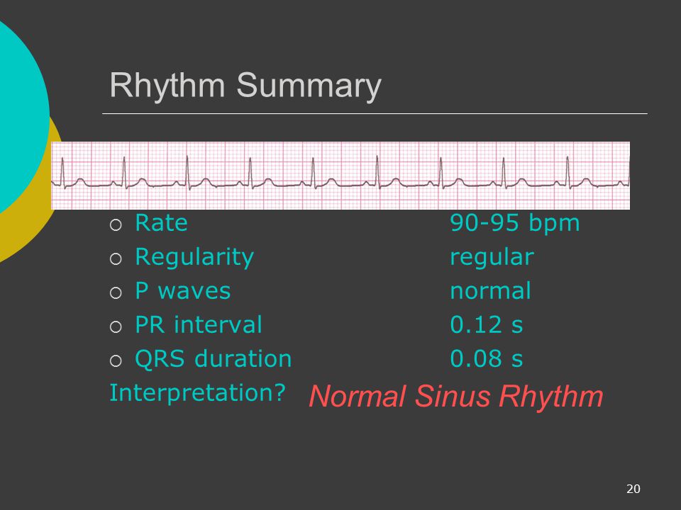 Rhythm Summary Normal Sinus Rhythm Rate bpm Regularity regular