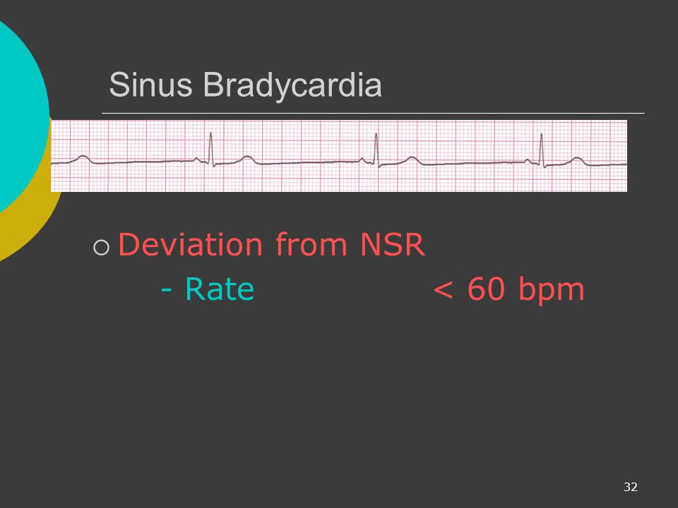 Sinus Bradycardia Deviation from NSR - Rate < 60 bpm