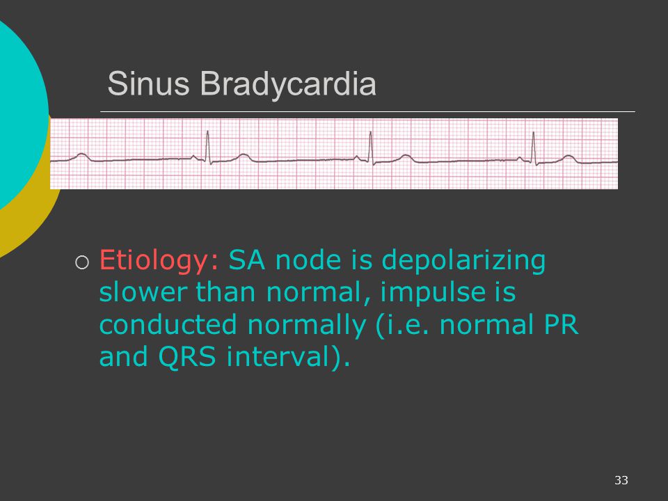 Sinus Bradycardia Etiology: SA node is depolarizing slower than normal, impulse is conducted normally (i.e.