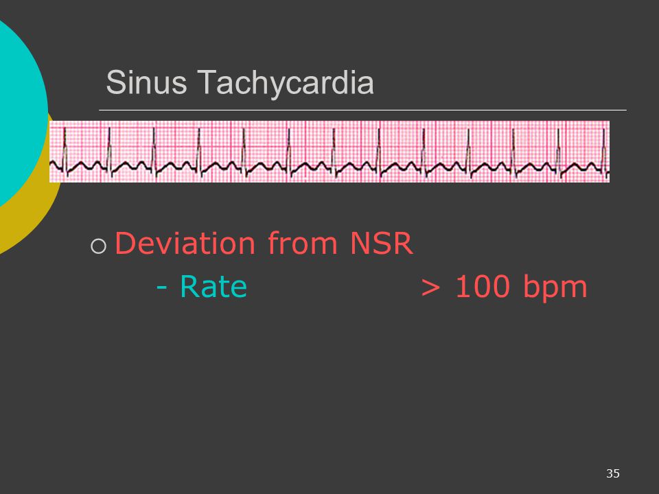 Sinus Tachycardia Deviation from NSR - Rate > 100 bpm