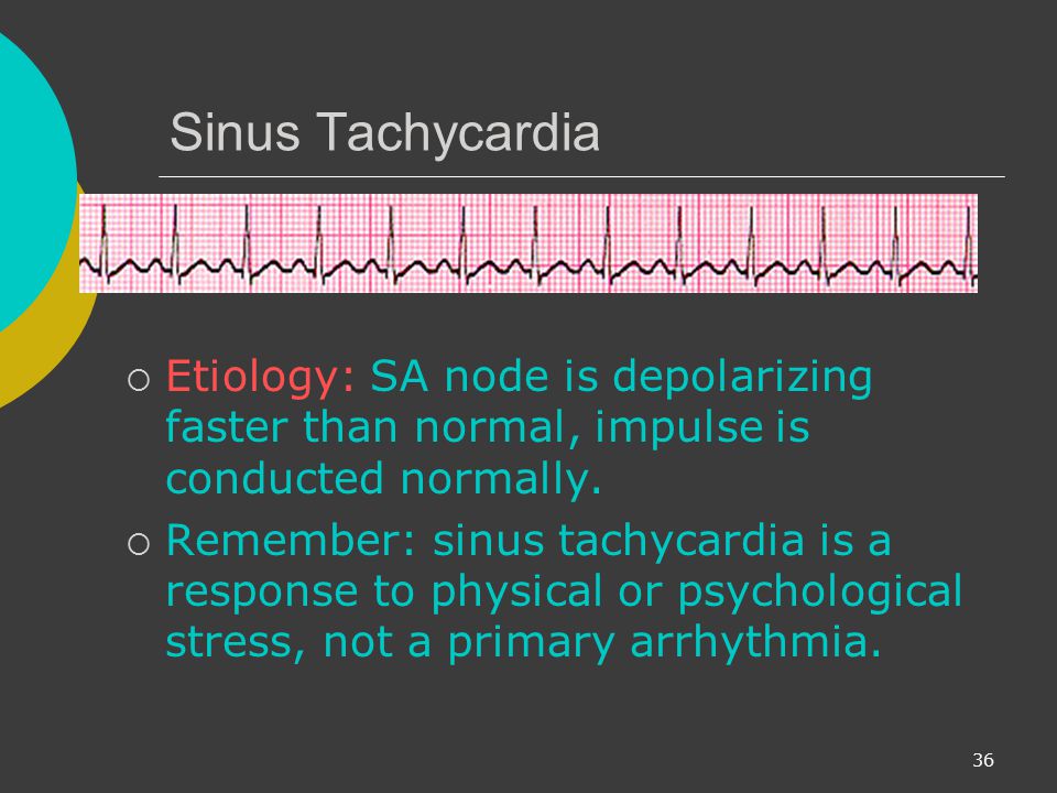 Sinus Tachycardia Etiology: SA node is depolarizing faster than normal, impulse is conducted normally.