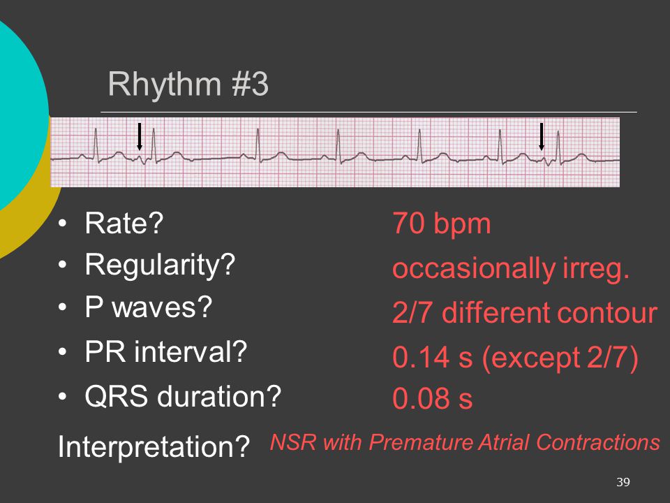 Rhythm #3 Rate 70 bpm Regularity occasionally irreg. P waves