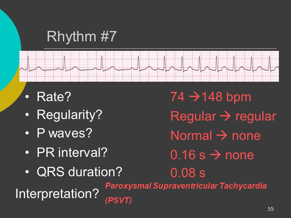 Rhythm #7 Rate 74 148 bpm Regularity Regular  regular P waves