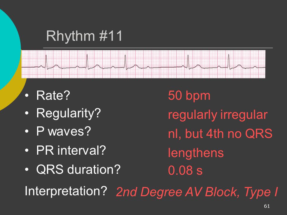 Rhythm #11 Rate 50 bpm Regularity regularly irregular P waves