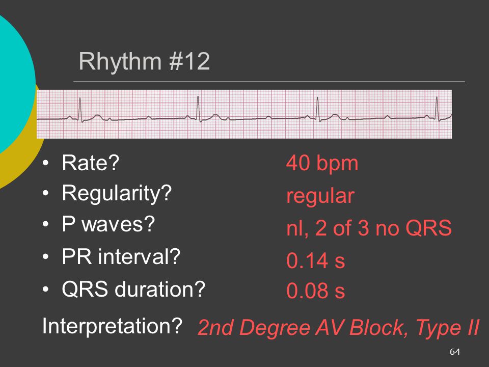 Rhythm #12 Rate 40 bpm Regularity regular P waves nl, 2 of 3 no QRS