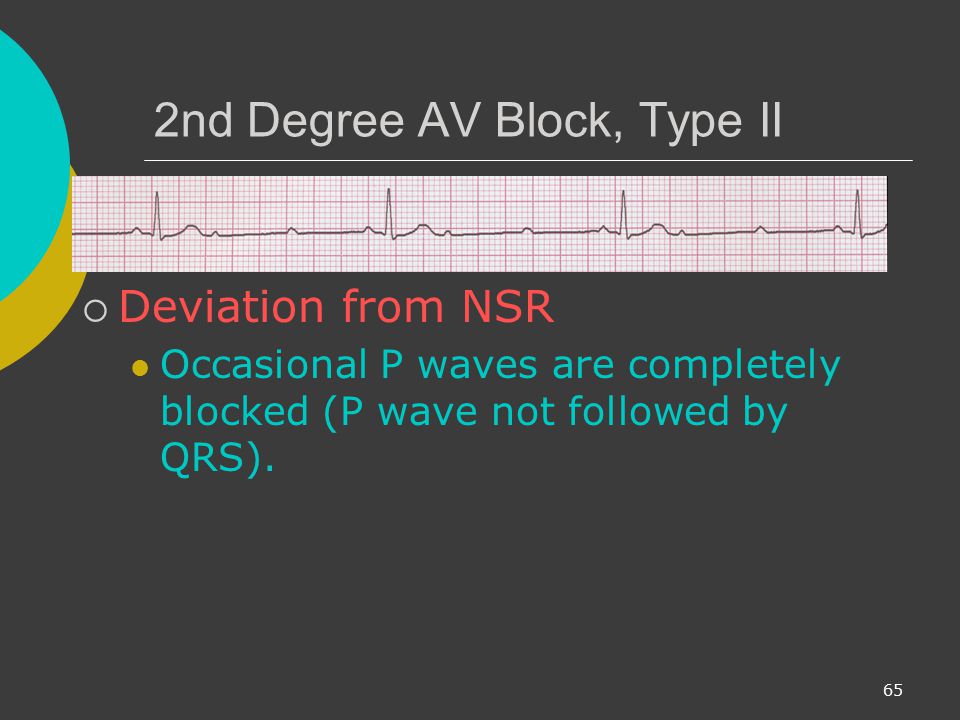 2nd Degree AV Block, Type II