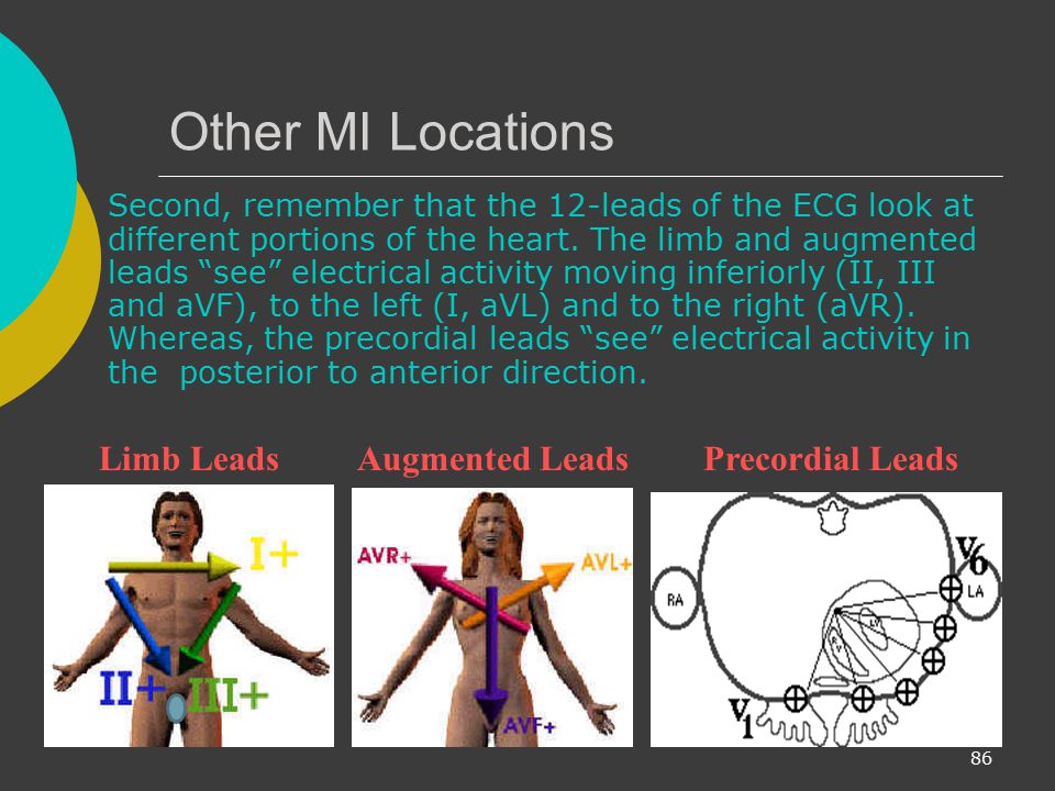 Other MI Locations Limb Leads Augmented Leads Precordial Leads