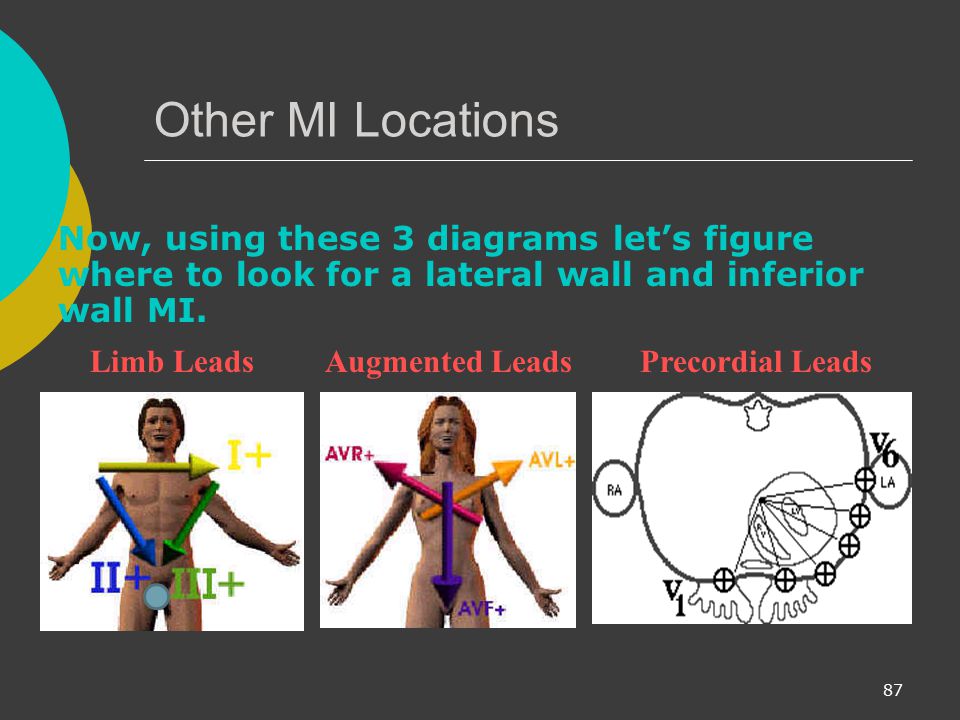 Other MI Locations Now, using these 3 diagrams let’s figure where to look for a lateral wall and inferior wall MI.