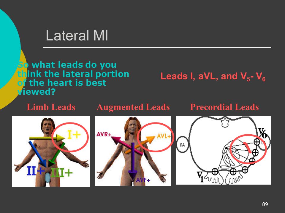 Lateral MI Leads I, aVL, and V5- V6 Limb Leads Augmented Leads