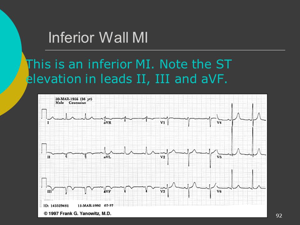 Inferior Wall MI This is an inferior MI. Note the ST elevation in leads II, III and aVF.