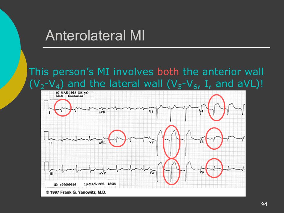 Anterolateral MI This person’s MI involves both the anterior wall (V2-V4) and the lateral wall (V5-V6, I, and aVL)!