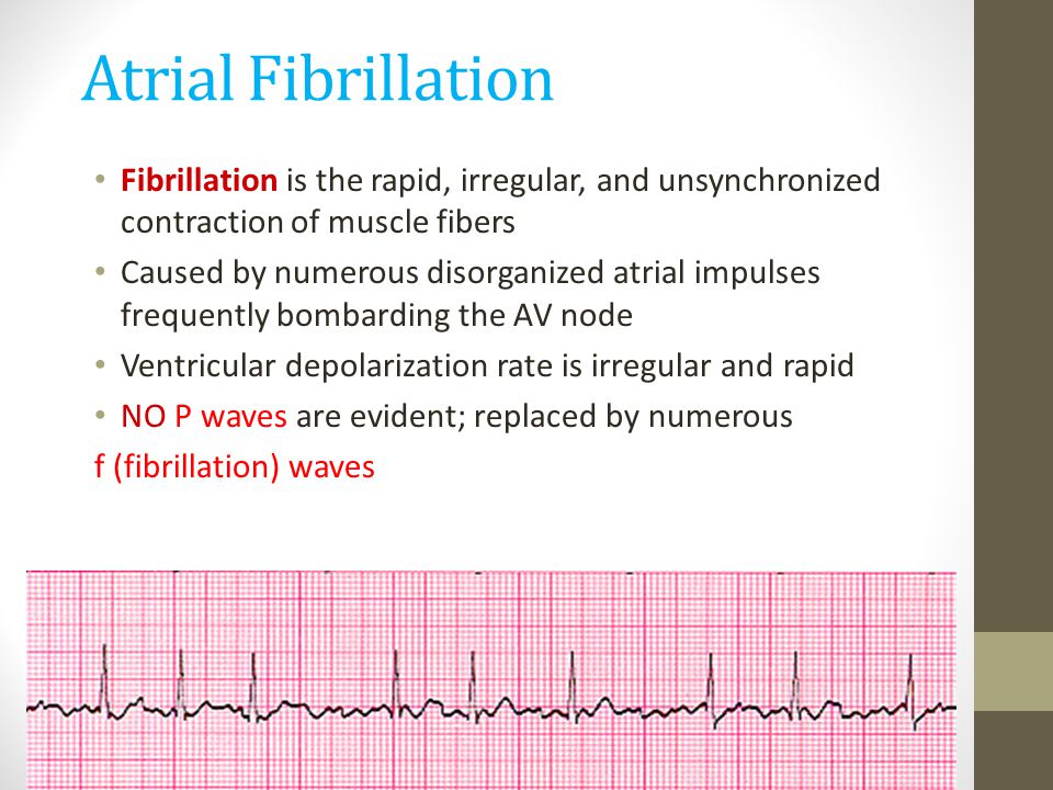 Atrial Fibrillation Fibrillation is the rapid, irregular, and unsynchronized contraction of muscle fibers.