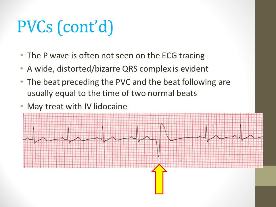 PVCs (cont’d) The P wave is often not seen on the ECG tracing