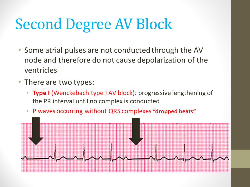 Second Degree AV Block Some atrial pulses are not conducted through the AV node and therefore do not cause depolarization of the ventricles.