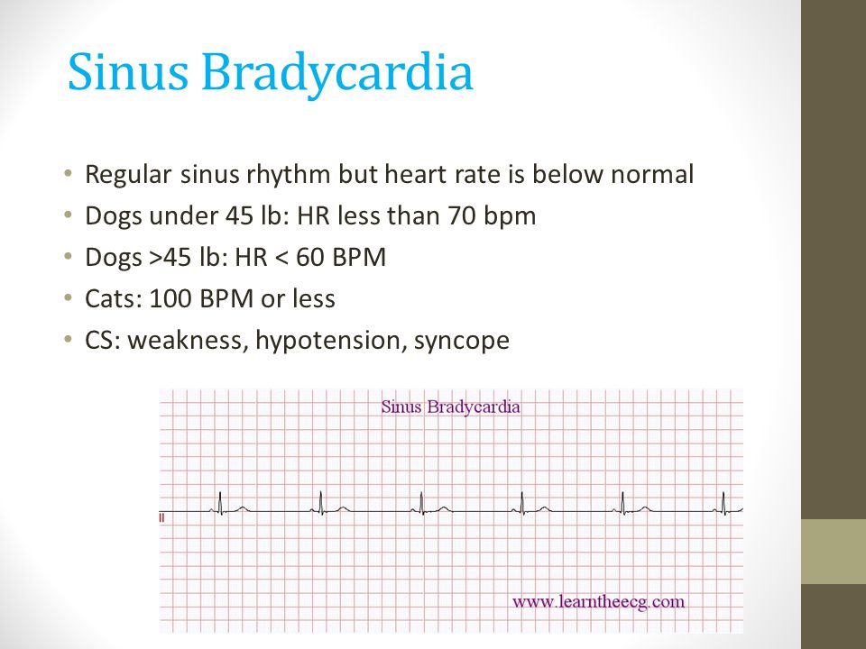 Sinus Bradycardia Regular sinus rhythm but heart rate is below normal