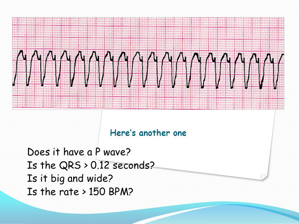 Does it have a P wave Is the QRS > 0.12 seconds