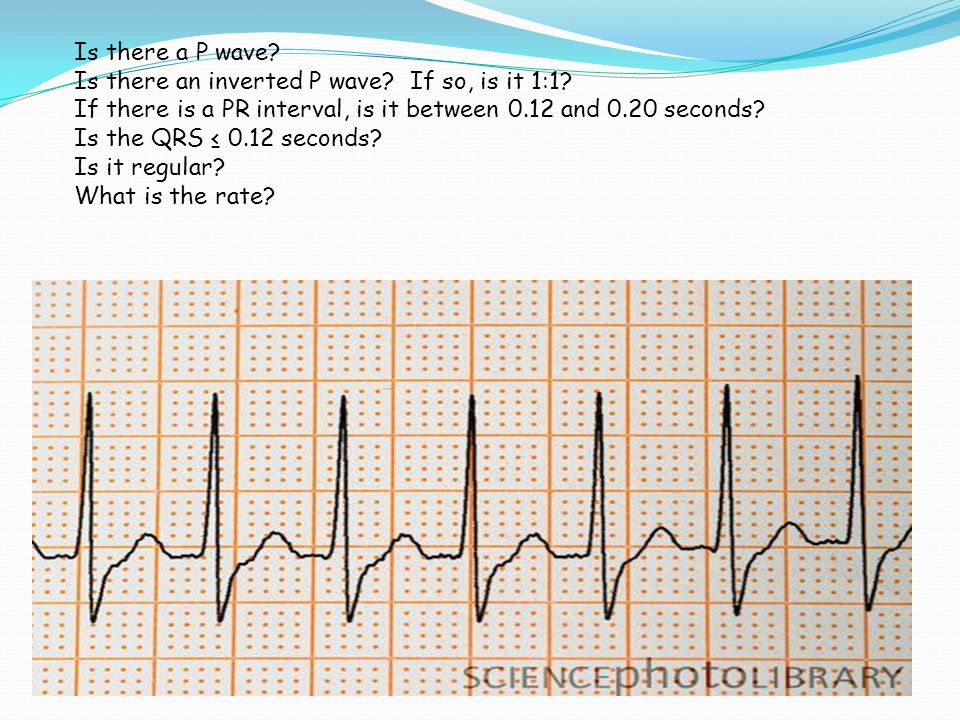 Is there a P wave Is there an inverted P wave If so, is it 1:1 If there is a PR interval, is it between 0.12 and 0.20 seconds