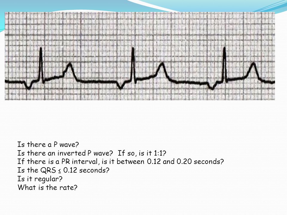 Is there a P wave Is there an inverted P wave If so, is it 1:1 If there is a PR interval, is it between 0.12 and 0.20 seconds