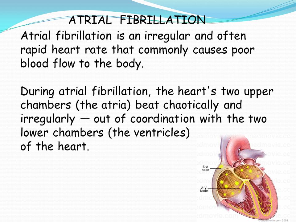ATRIAL FIBRILLATION Atrial fibrillation is an irregular and often rapid heart rate that commonly causes poor blood flow to the body.